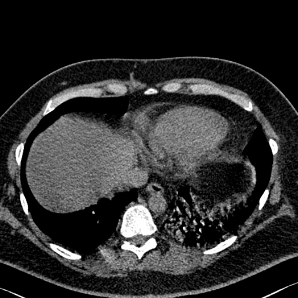 Adenoid cystic carcinoma of the trachea (Radiopaedia 49042-54137 Axial non-contrast 272).jpg