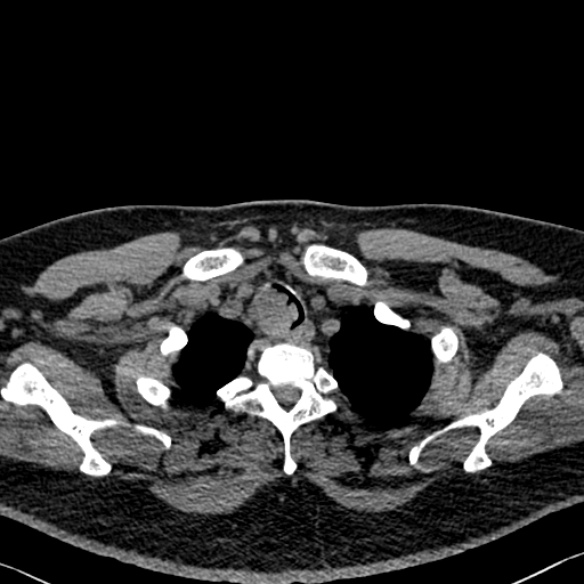 Adenoid cystic carcinoma of the trachea (Radiopaedia 49042-54137 Axial non-contrast 33).jpg