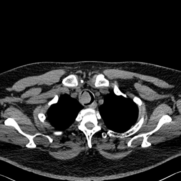 Adenoid cystic carcinoma of the trachea (Radiopaedia 49042-54137 Axial non-contrast 42).jpg