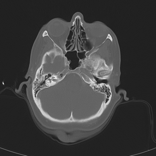 Adenoid cystic tumor of palate (Radiopaedia 46980-51518 Axial bone window 15).png