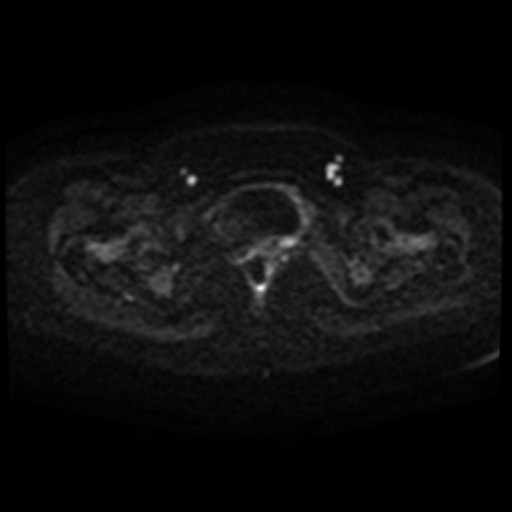 Adenoma malignum of cervix (Radiopaedia 66441-75705 Axial DWI 95).jpg