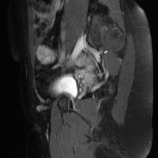 File:Adenoma malignum of cervix (Radiopaedia 66441-75705 Sagittal T1 C+ fat sat 20).jpg