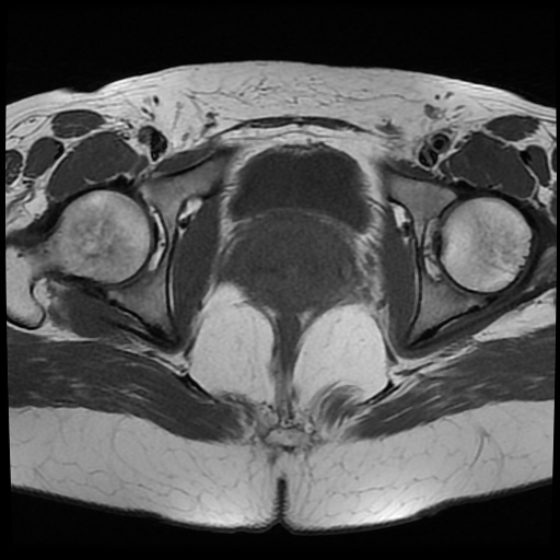 File:Adenomyosis-scar endometriosis (Radiopaedia 65863-75022 Axial T1 24).jpg