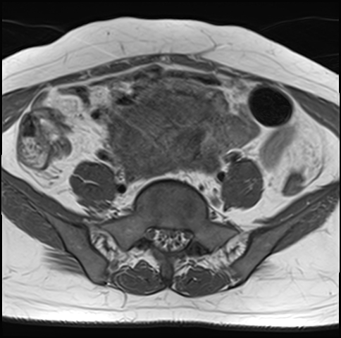 File:Adenomyosis - ovarian endometriomas (Radiopaedia 67031-76350 Axial T1 6).jpg