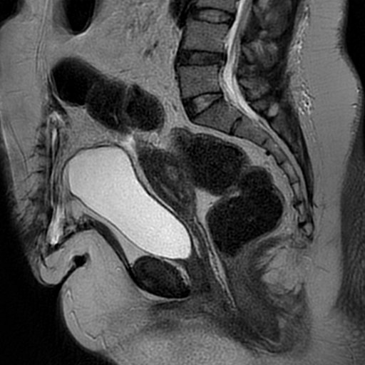 File:Adenomyosis within a didelphys uterus (Radiopaedia 70175-80215 Sagittal T2 19).jpg