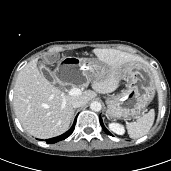 Adhesional small bowel obstruction (Radiopaedia 48397-53305 Axial C+ portal venous phase 13).jpg