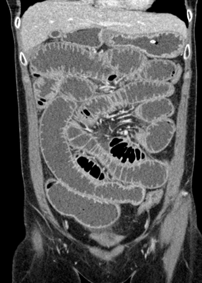 Adhesional small bowel obstruction (Radiopaedia 48397-53305 Coronal C+ portal venous phase 110).jpg