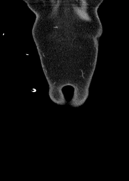 Adhesional small bowel obstruction (Radiopaedia 48397-53305 Coronal C+ portal venous phase 16).jpg