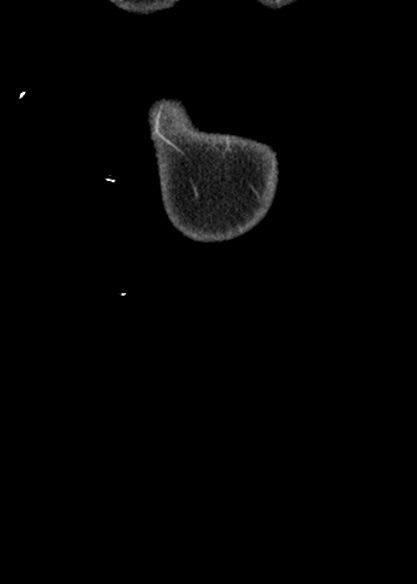 File:Adhesional small bowel obstruction (Radiopaedia 48397-53305 Coronal C+ portal venous phase 3).jpg