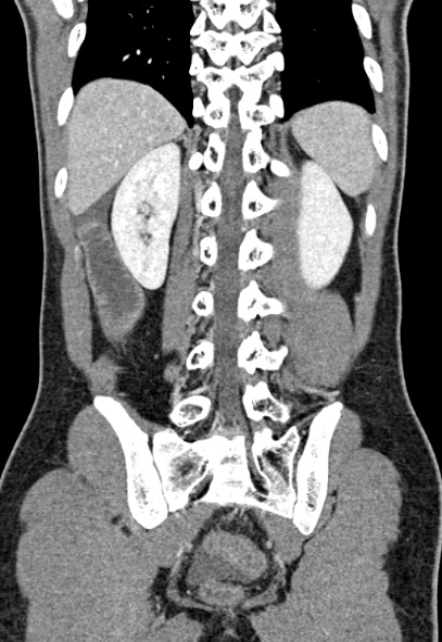 File:Adhesional small bowel obstruction (Radiopaedia 52107-57980 Coronal C+ portal venous phase 63).jpg