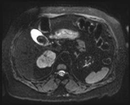 Adrenal cortical carcinoma (Radiopaedia 64017-72770 Axial DWI 13).jpg