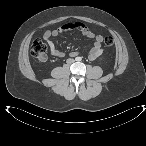 File:Adrenal cyst (Radiopaedia 45625-49778 AXIAL THICK 60 sec 63).png