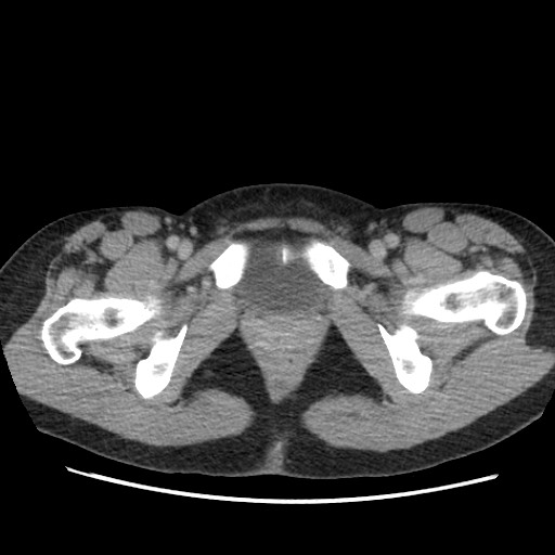 Adrenal cyst (Radiopaedia 64869-73813 Axial C+ portal venous phase 80).jpg