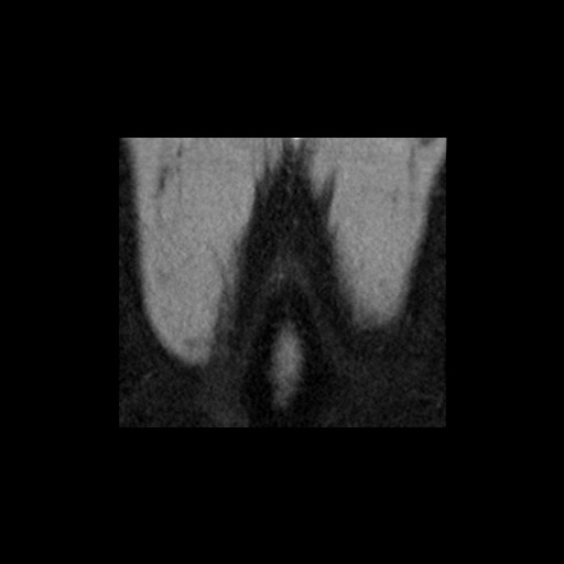 Adrenal gland trauma (Radiopaedia 81351-95079 Coronal non-contrast 87).jpg