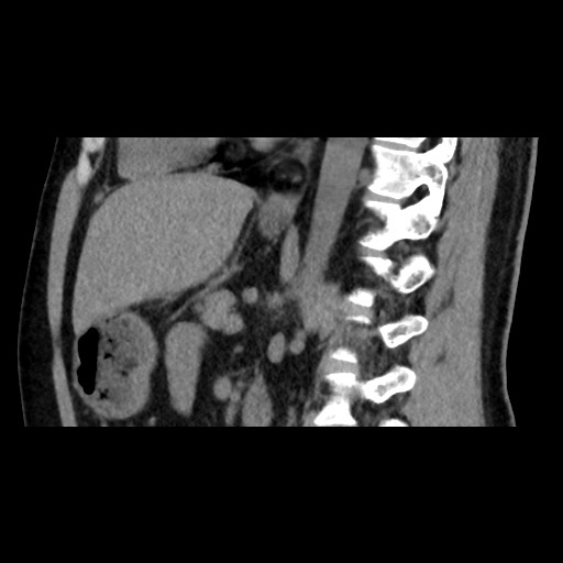 Adrenal gland trauma (Radiopaedia 81351-95079 Sagittal non-contrast 57).jpg