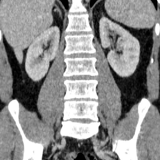 File:Adrenal glands (normal CT anatomy) (Radiopaedia 16570-105725 Coronal 15).jpg