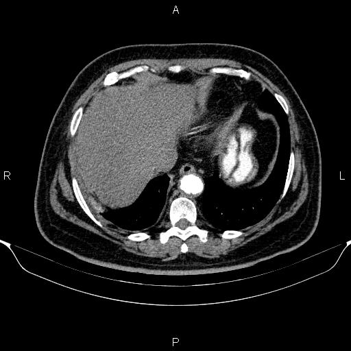 File:Adrenal hemorrhage (Radiopaedia 62622-70916 Axial C+ arterial phase 33).jpg