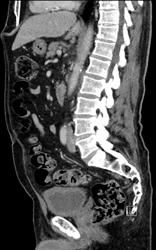 Adrenal lymphoma (Radiopaedia 73730-84529 Sagittal C+ portal venous phase 56).jpg
