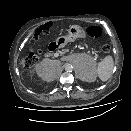 Adrenal lymphoma (Radiopaedia 84145-99415 Axial C+ portal venous phase 30).jpg