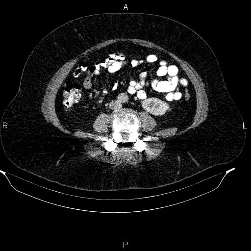 File:Adrenal myelolipoma (Radiopaedia 84319-99617 Axial renal cortical phase 67).jpg
