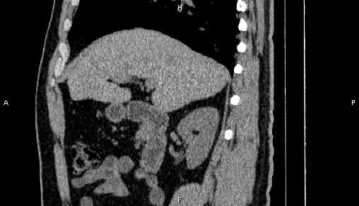 Adrenal myelolipoma (Radiopaedia 84321-99619 Sagittal non-contrast 38).jpg