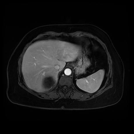 Adrenal myelolipoma - MRI (Radiopaedia 83249-97646 T1 fat sat arterial phase 13).jpg