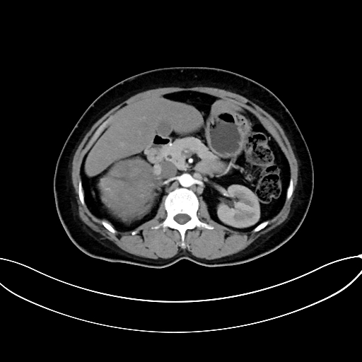 Adrenocortical carcinoma (Radiopaedia 87281-103569 Axial C+ arterial phase 35).jpg