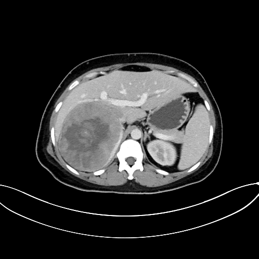 File:Adrenocortical carcinoma (Radiopaedia 87281-103569 Axial C+ portal venous phase 26).jpg