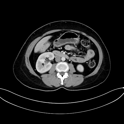 Adrenocortical carcinoma (Radiopaedia 87281-103569 Axial C+ portal venous phase 43).jpg