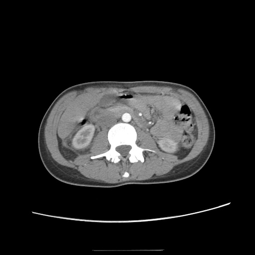 Adult polycystic kidney disease (Radiopaedia 48845-53876 Axial renal cortical phase 32).jpg