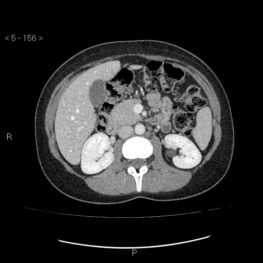 Adult transient intestinal intussusception (Radiopaedia 34853-36310 Axial C+ portal venous phase 21).jpg