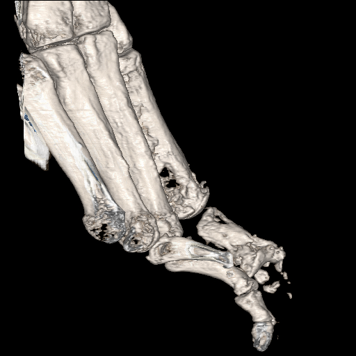 File:Advanced osteomyelitis due to open metatarsal fracture (Radiopaedia 83891-99095 VRT 20).jpg