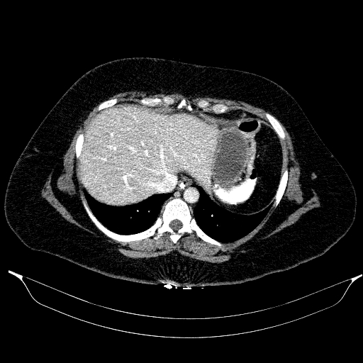 Afferent loop syndrome - secondary to incarcerated trocar site hernia (Radiopaedia 82959-97305 Axial C+ portal venous phase 32).jpg