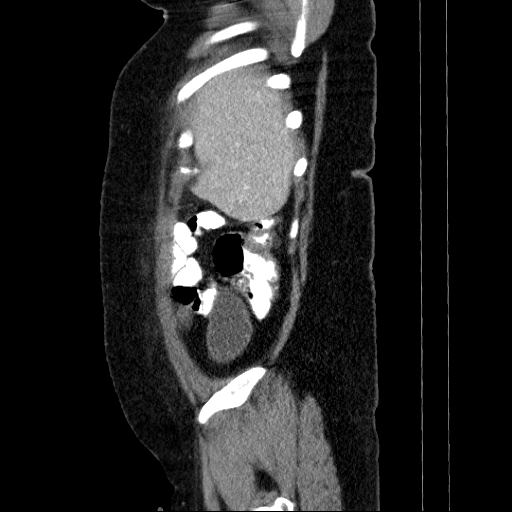 File:Afferent loop syndrome - secondary to incarcerated trocar site hernia (Radiopaedia 82959-97305 Sagittal C+ portal venous phase 136).jpg