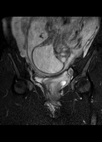 File:Aggressive angiomyxoma of the pelvis and perineum (Radiopaedia 59162-66479 Coronal T2 fat sat 10).jpg