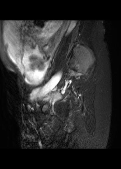 File:Aggressive angiomyxoma of the pelvis and perineum (Radiopaedia 59162-66479 Sagittal T2 fat sat 2).jpg