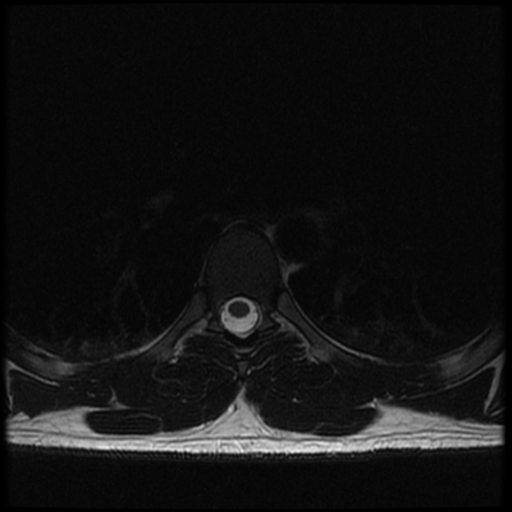 File:Aggressive vertebral hemangioma (Radiopaedia 39937-42404 Axial T2 21).png