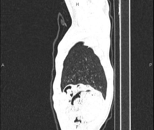 Air bronchogram in pneumonia (Radiopaedia 85719-101512 Sagittal lung window 95).jpg