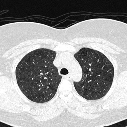 File:Air trapping in small airway disease (Radiopaedia 61685-69694 Axial lung window 44).jpg