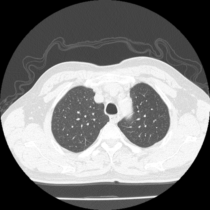 Airway foreign body in adult (Radiopaedia 85907-101779 Axial lung window 23).jpg