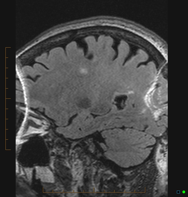 Aliasing artifact causing a spurious cerebellar lesion (Radiopaedia 48783-53810 Sagittal FLAIR 6).jpg