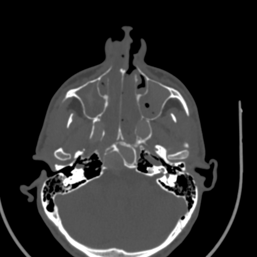 Allergic fungal sinusitis (Radiopaedia 88725-105456 Axial bone window 16).jpg