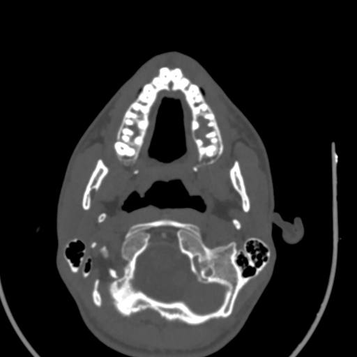 Allergic fungal sinusitis (Radiopaedia 88725-105456 Axial bone window 2).jpg