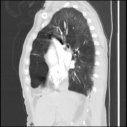 Alpha-1-antitrypsin deficiency (Radiopaedia 64893-73840 Sagittal lung window 22).jpg