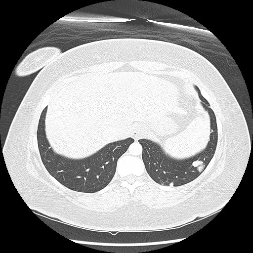 Alveolar soft part sarcoma - right leg (Radiopaedia 59432-67091 Axial lung window 96).jpg