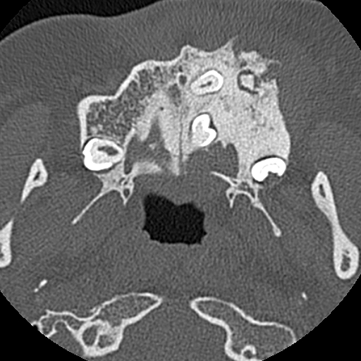 File:Ameloblastic fibro-odontoma (Radiopaedia 18843-18780 C 36).jpg