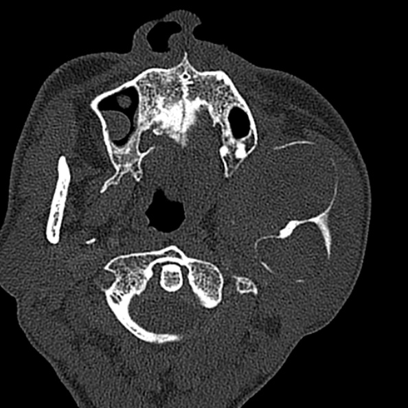 Ameloblastoma (Radiopaedia 51921-57766 Axial bone window 107).jpg
