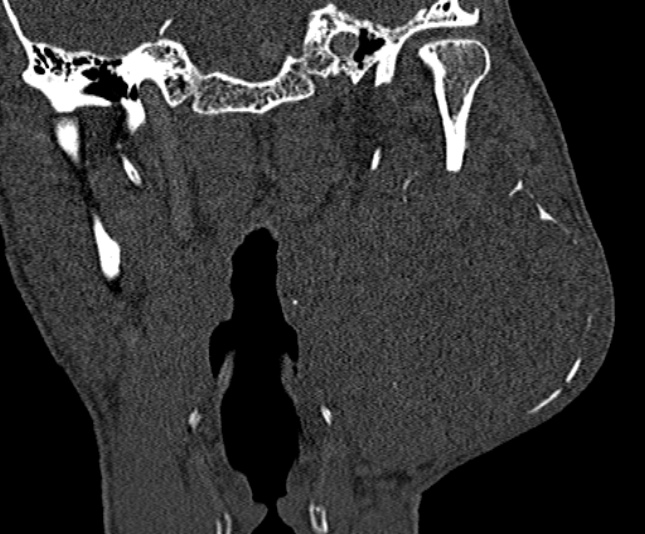 Ameloblastoma (Radiopaedia 51921-57766 Coronal bone window 186).jpg