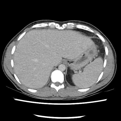Amoebic liver abscesses (Radiopaedia 55536-62010 A 18).jpg