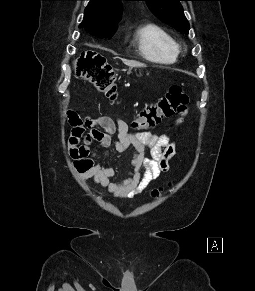 Ampullary adenocarcinoma (Radiopaedia 59373-66734 D 10).jpg